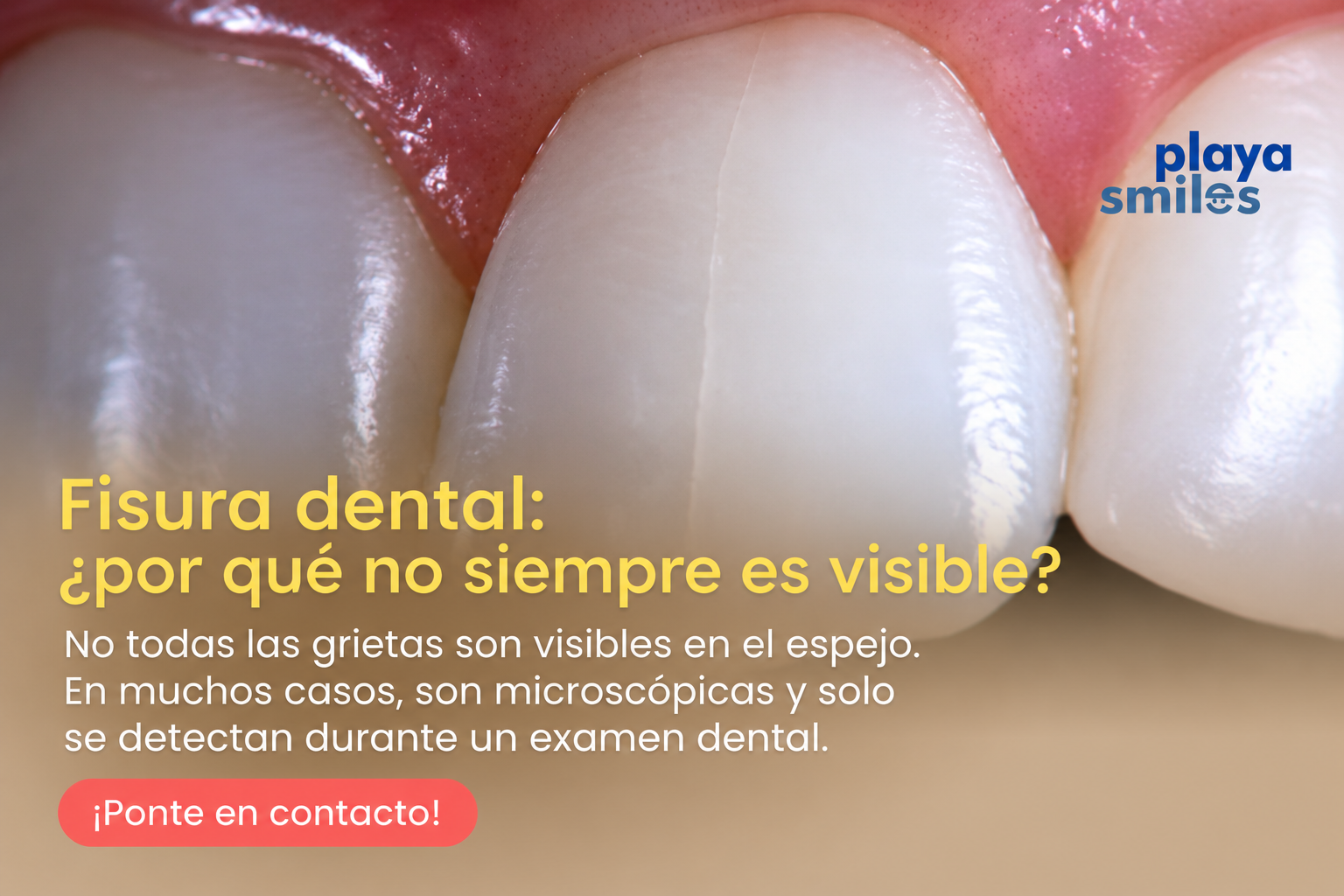 🦷 Fisura dental: ¿por qué no siempre es visible?