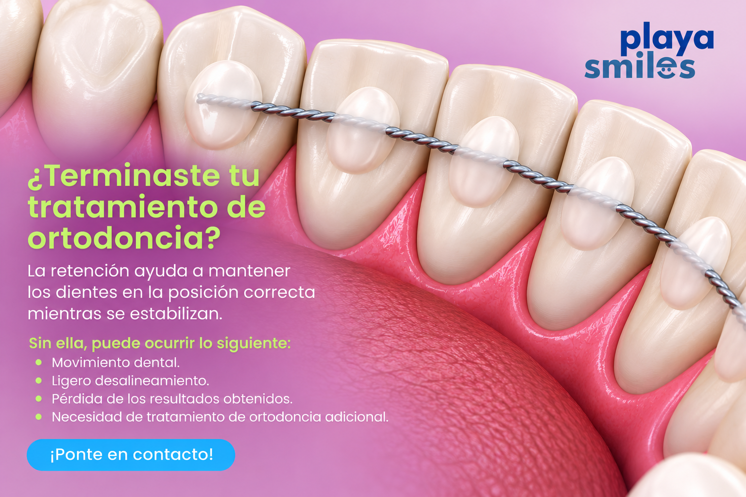 ¿Terminaste tu tratamiento de ortodoncia? ¡El retenedor es fundamental!